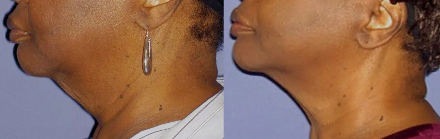 Kosmetik | Radiofrequenz-Lifting (Forma™) | «Strafft, stimuliert Collagen – ganz ohne OP»