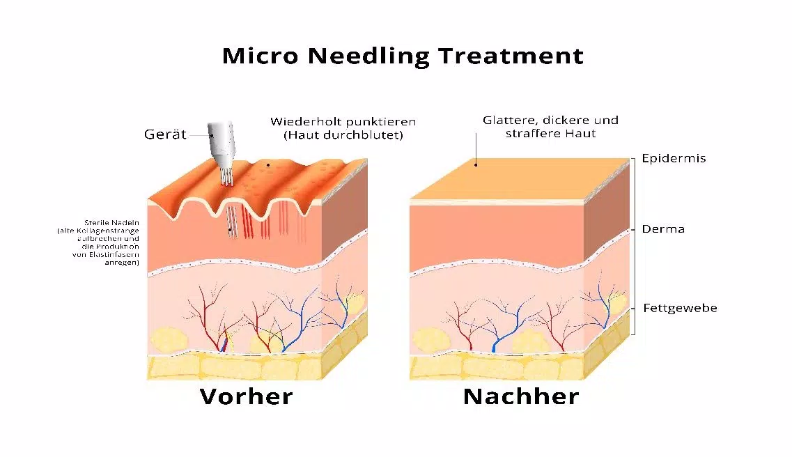 Skin Micro-Needling ist ein neues und sehr wirksames Verfahren zur Regeneration und Verjüngung verschiedener Hautpartien.